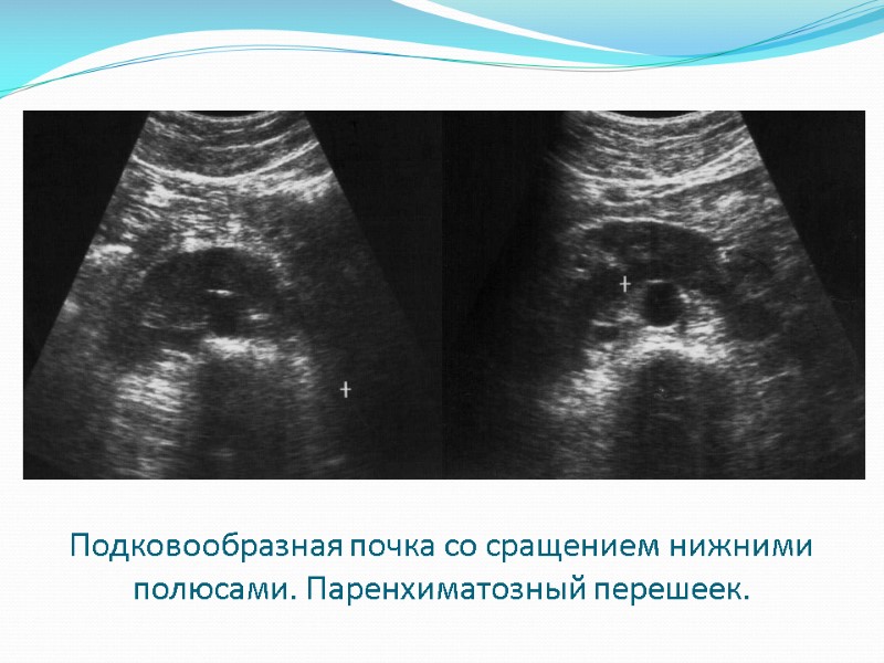 Подковообразная почка со сращением нижними полюсами. Паренхиматозный перешеек.